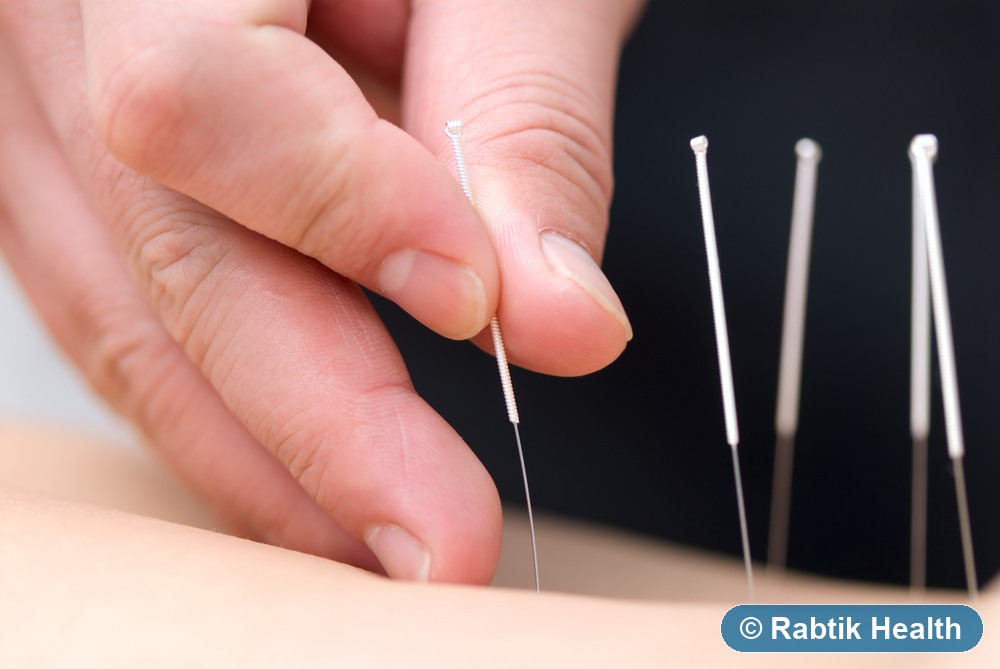 Acupuncture and dry needling treatment