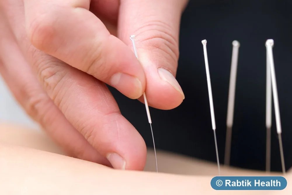 Illustrative acupuncture therapy image